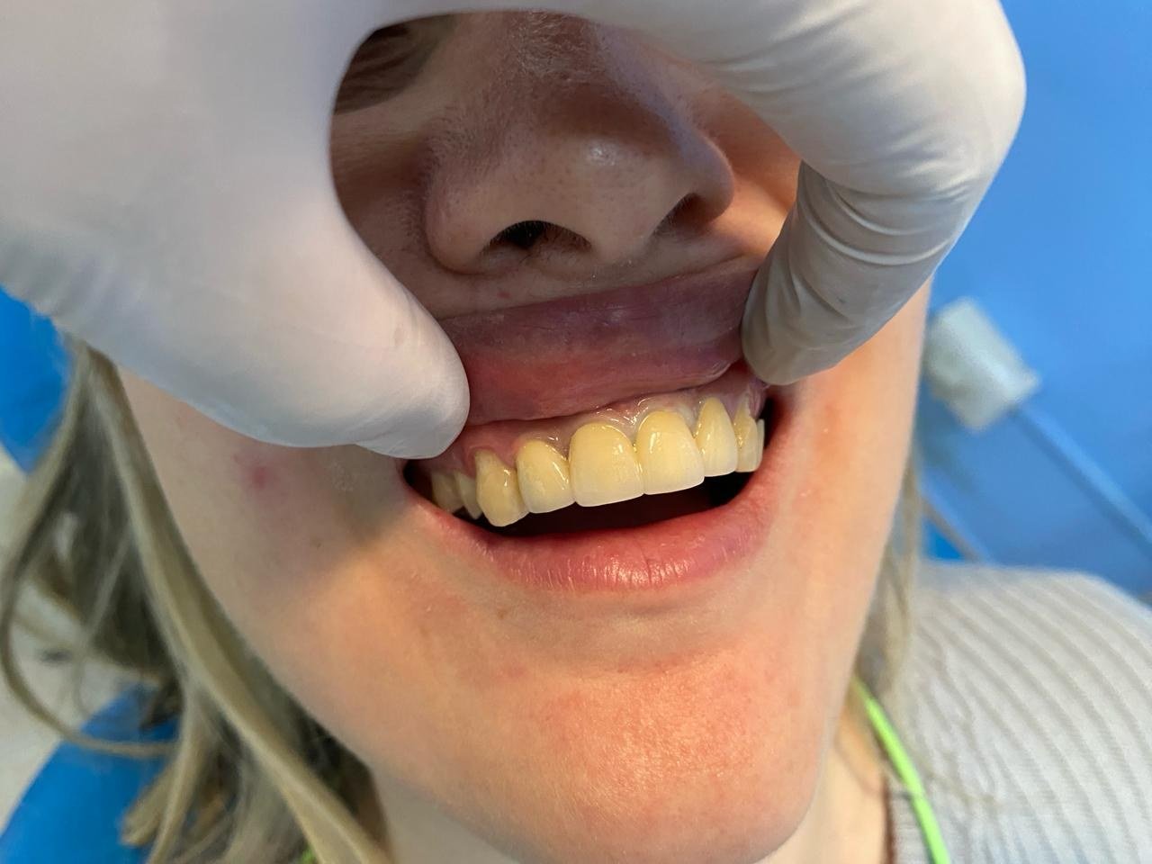 Caso clínico rehabilitación dental